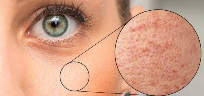 Acupuntura para las manchas faciales de Acupuntura Bilbao EQUILIBRIO Bilbao by Txema Azkona