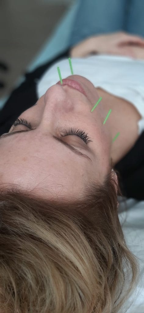 Curso de lifting facial con acupuntura método EQUILIBRIO en Logroño